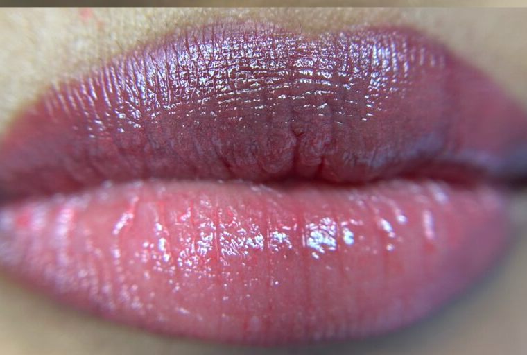 Dark Lip Neutralization – Even-Toned Lip Enhancement after treatment