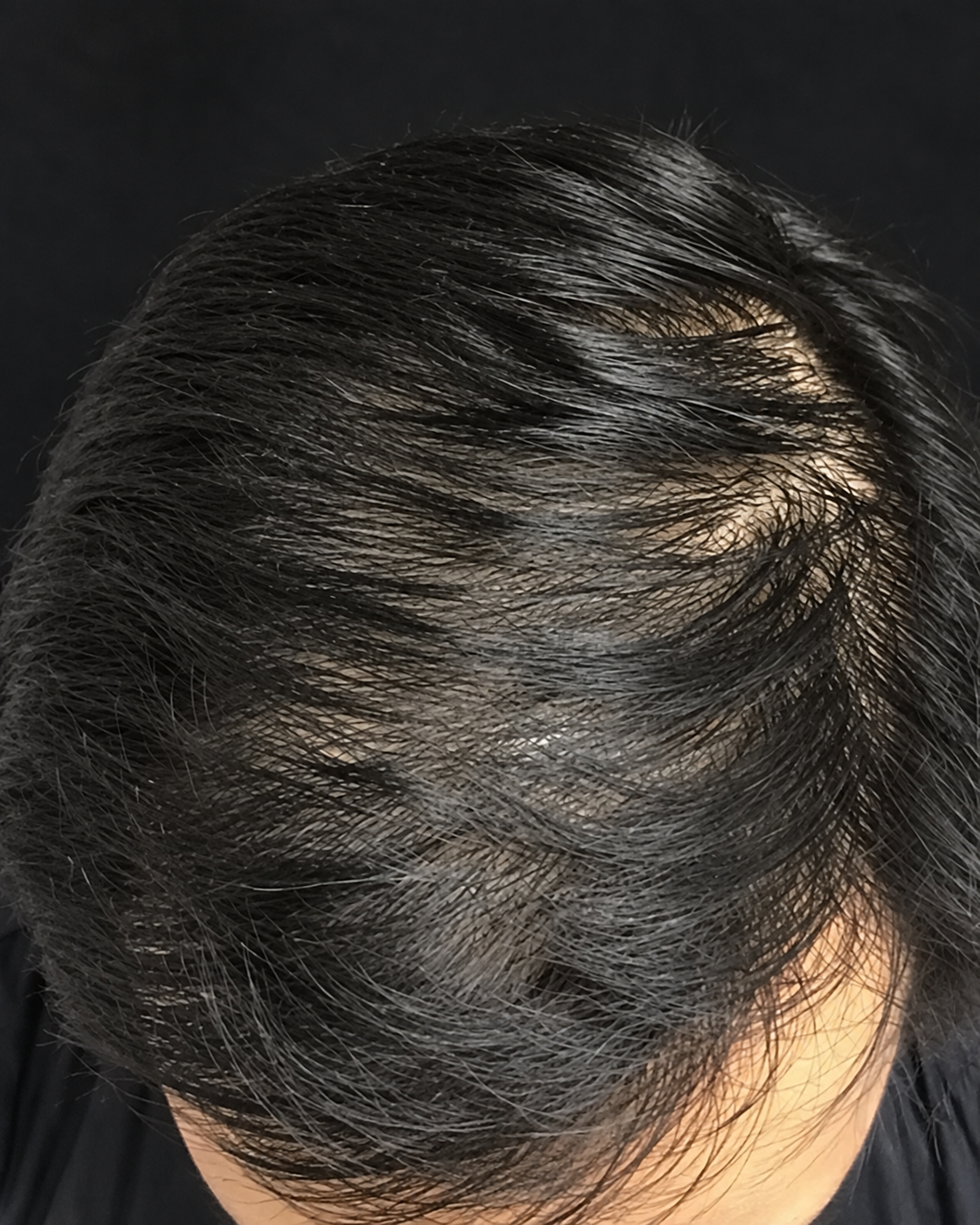 PRP Hair Treatment – Hair Growth Support after treatment