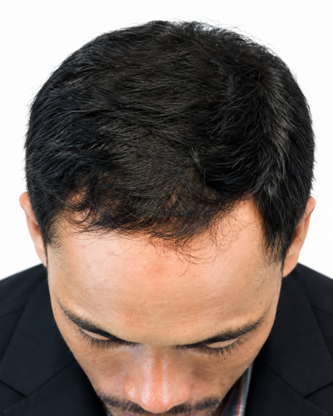 Scalp Microneedling – Hair Growth Support after treatment
