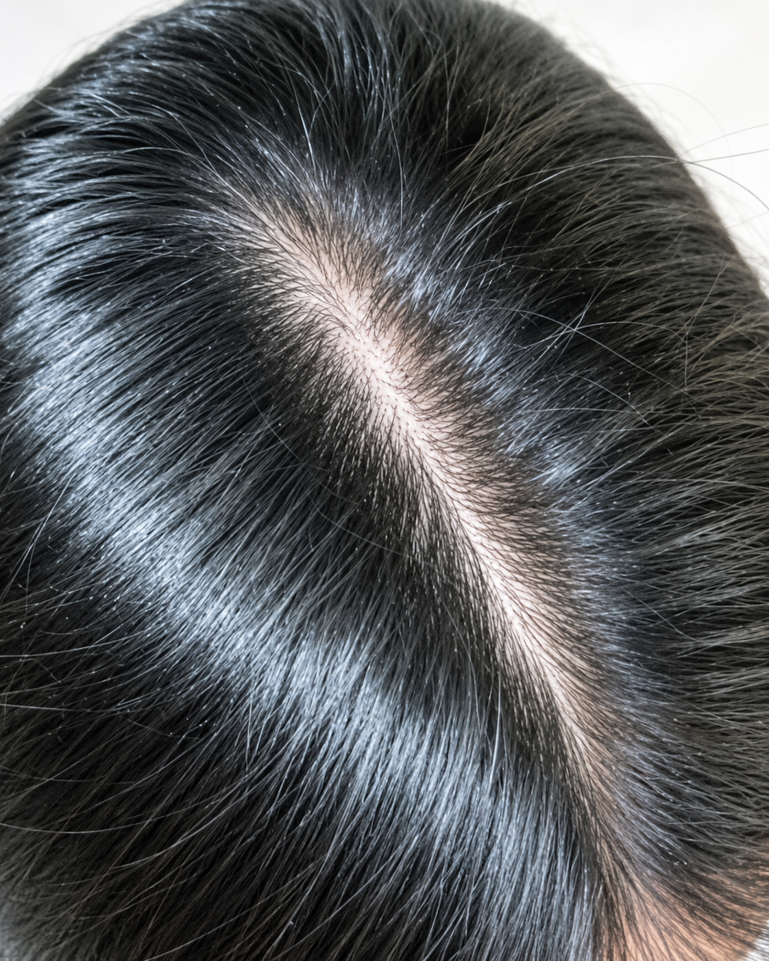 Dandruff Treatment – Scalp Care & Flake Control after treatment