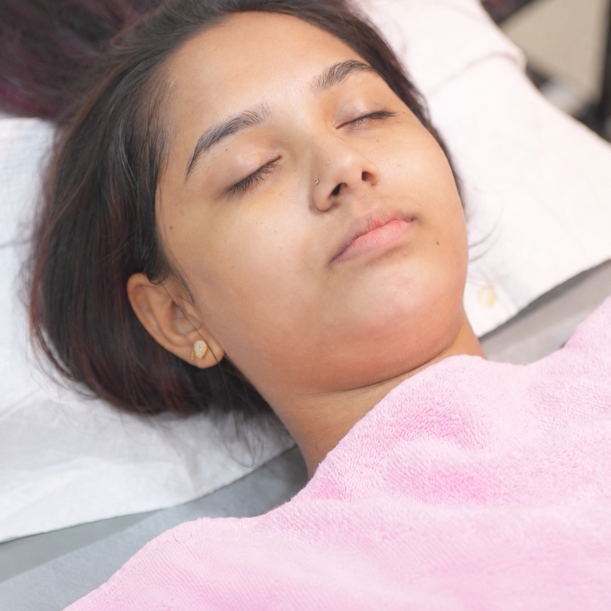 HydraFacial – Deep Cleansing & Hydration after treatment