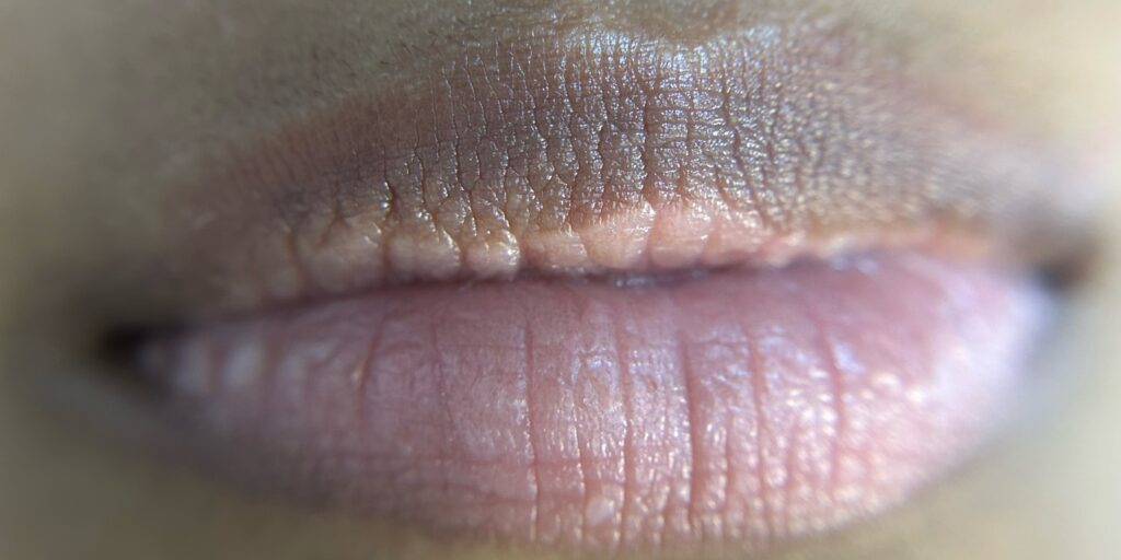 Dark Lip Neutralization – Even-Toned Lip Enhancement before treatment