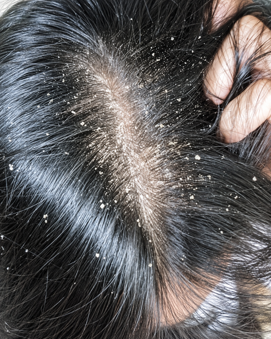 Dandruff Treatment – Scalp Care & Flake Control before treatment
