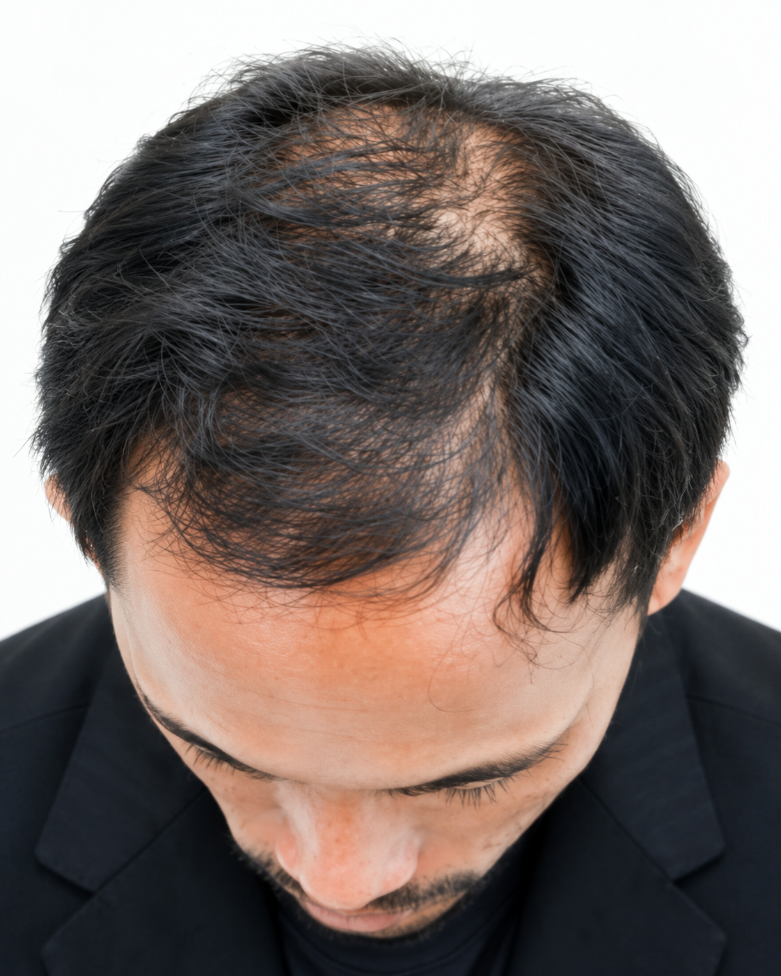Scalp Microneedling – Hair Growth Support before treatment