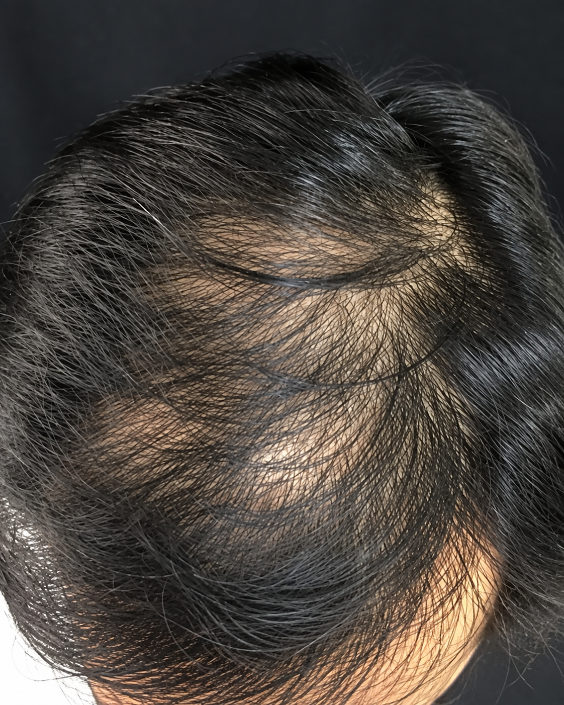 PRP Hair Treatment – Hair Growth Support before treatment